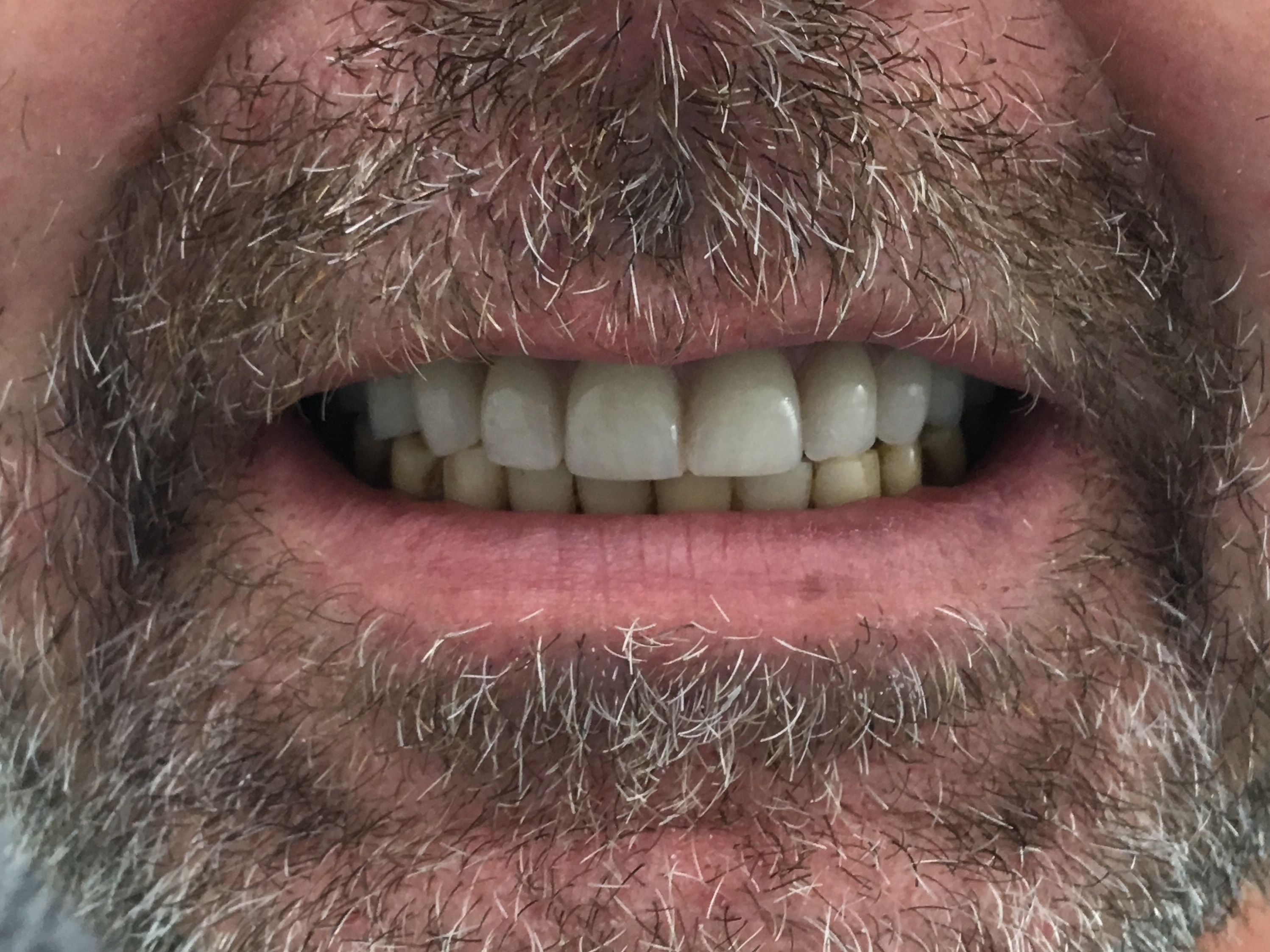 Review Implant Bangkok Dental Dentist Clinic By Bangkok Smile Dental 